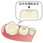 シーラントとは